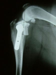 x-ray